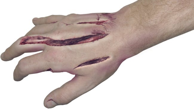 An injection injury most always is considered a surgical emergency. Surgery is required to relieve pressure in &ldquo;compartments&rdquo; of the hand and forearm in order to preserve blood flow and also to remove the injectate and damaged tissue. The wound typically is left open for 24 to 48 hours until a second surgery is performed to remove all possible injectate.